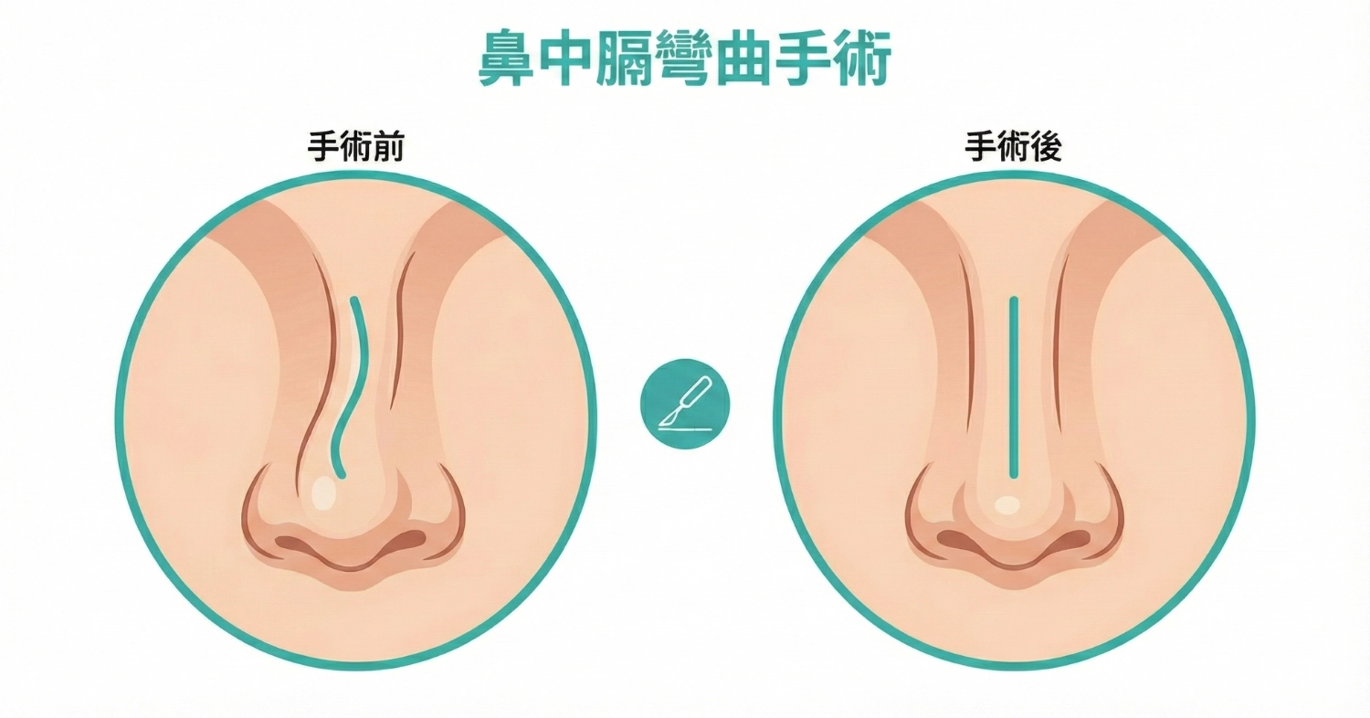 鼻塞看哪科_鼻塞治療全攻略_鼻中膈彎曲手術