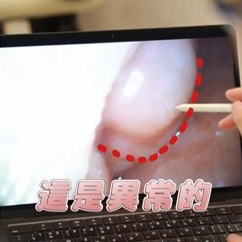 內視鏡看下鼻甲肥厚